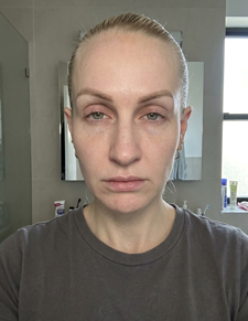 Before image for Karsen S.